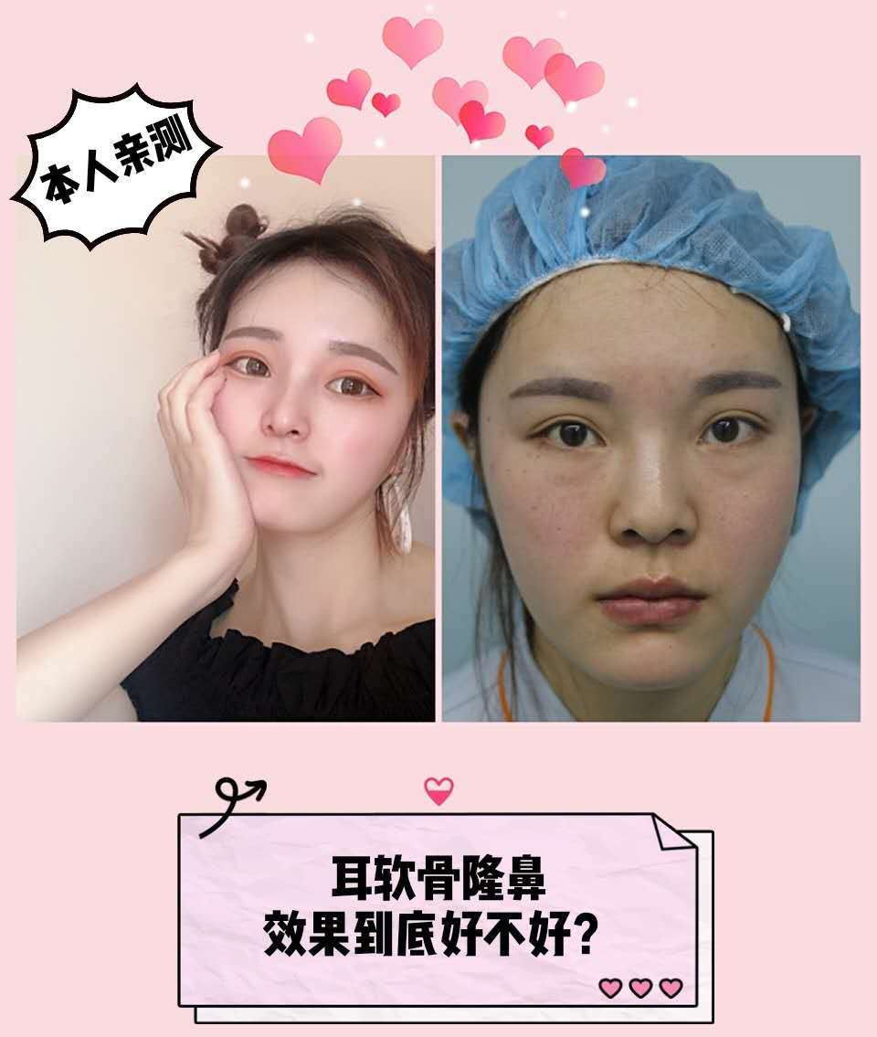 上海探店┃亲测:耳软骨隆鼻效果到底好不好?