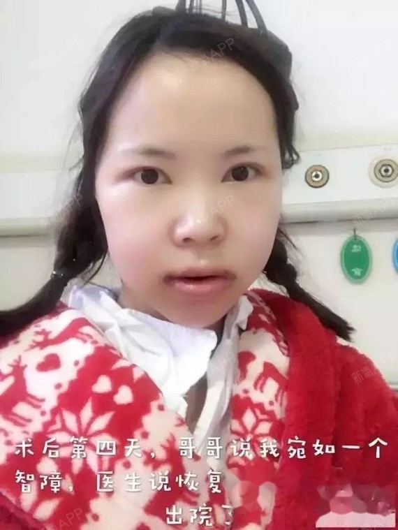 29岁蜕变地包天正颌术后8个月(详细对比图)
