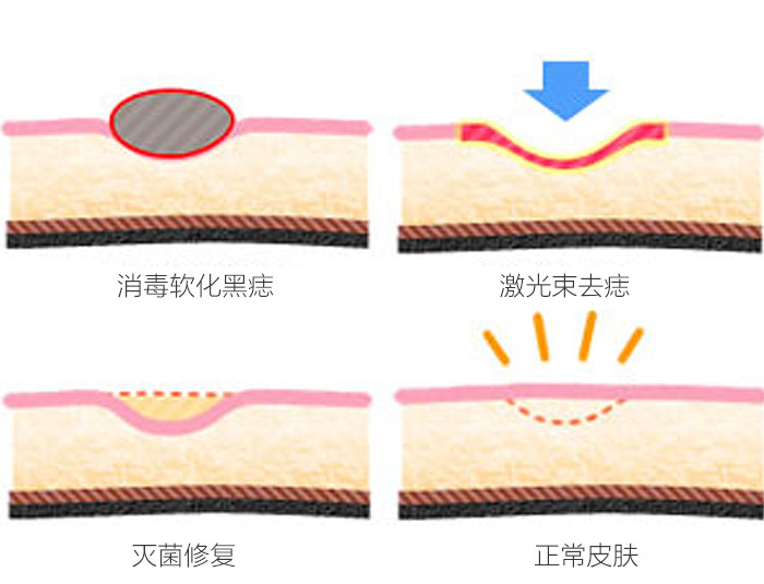 想做点痣的小可爱们点进来看看激光点痣之前术前应该注_圈子-新氧美容