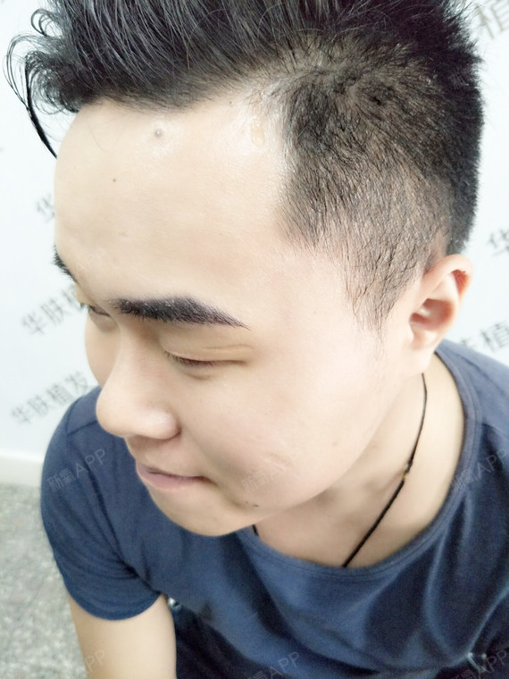 6791幸福生活从眉毛开始,手术第二天去医院拆_圈子-新氧美容整形