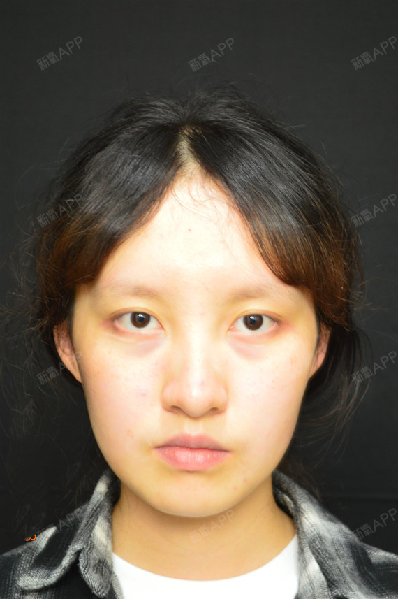 激光祛斑好不好_效果图_蹦个养生迪9激光祛斑