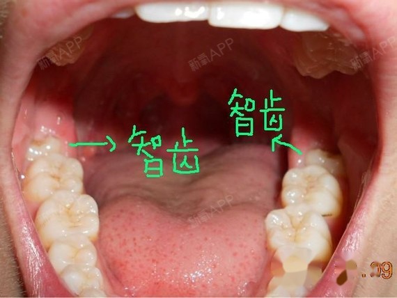 对照图.第三磨牙为智齿.如果这个位置没有牙_圈子-新氧美容整形