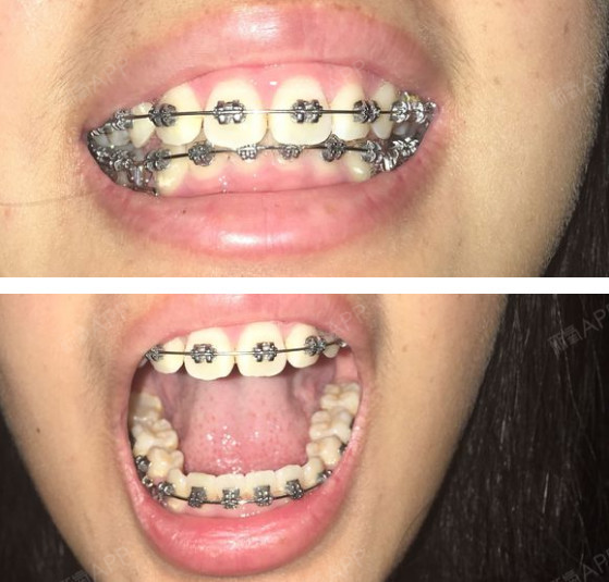 上排牙的缝基本上没了 ,下排牙的缝也变小了