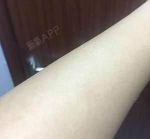 激光脱毛已经有10天了,手臂是很白吧!