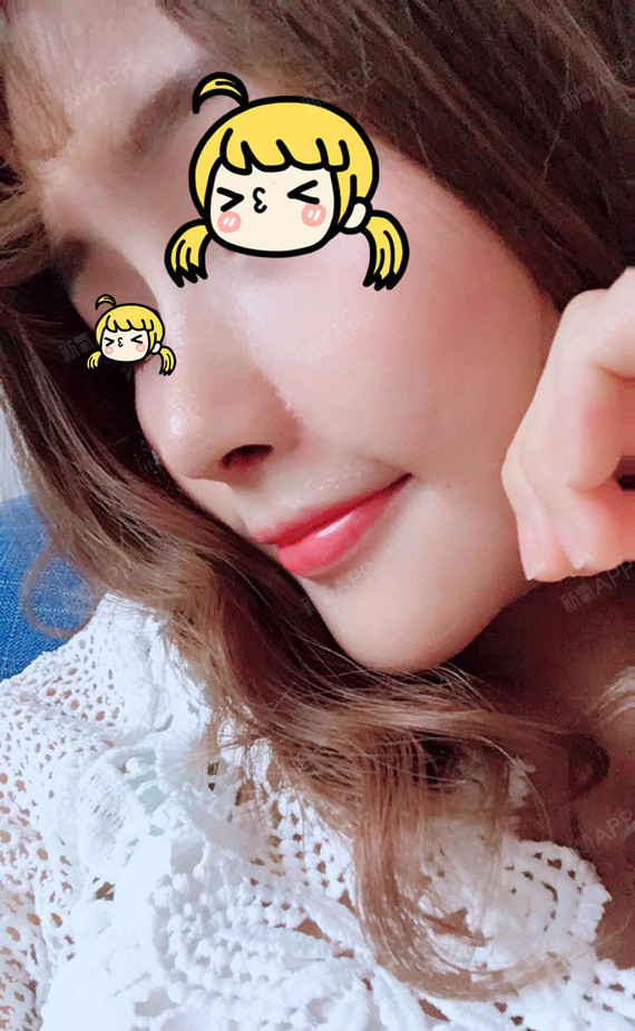 玻尿酸隆鼻一个星期了,鼻子效果很好,是自己想要的,_圈子-新氧美容