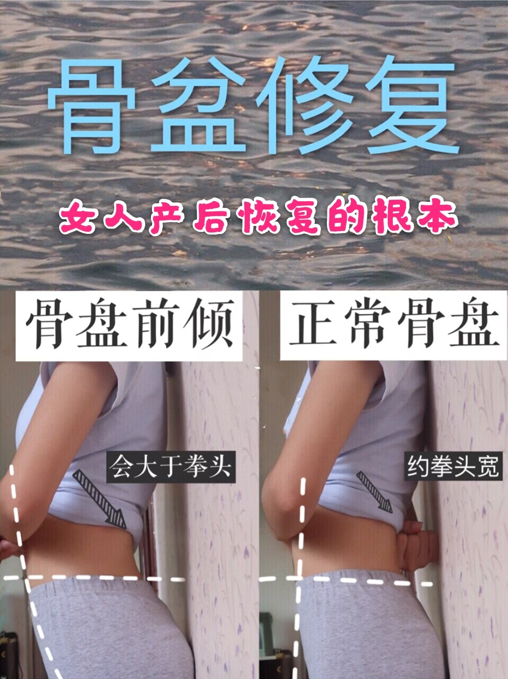 骨盆修复女人产后恢复的根本