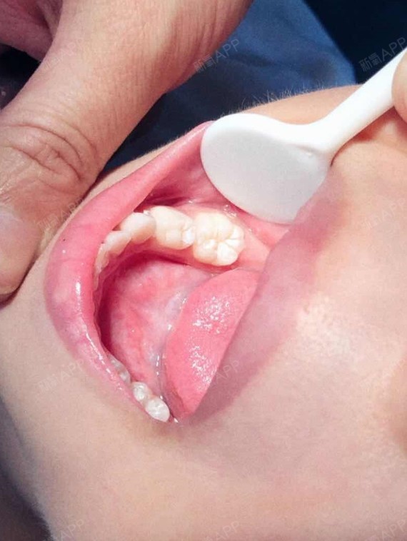 【大连沙医生】窝沟封闭打卡!近一年儿子的牙好了很多,开心的不得了.