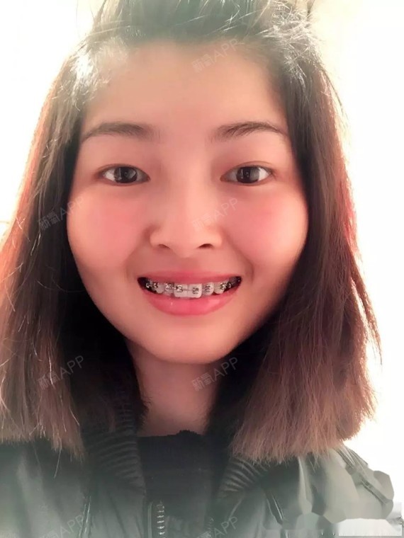 28岁高龄妹子的牙套