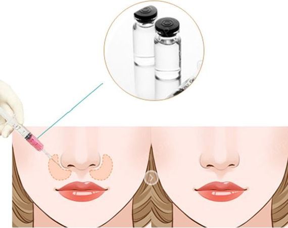 零失败!医美人教你玻尿酸也可以填充鼻基底我们需要有_圈子-新氧美容