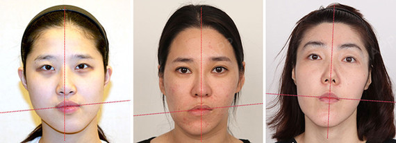 面部不对称是以脸的中央线为基准,左右均衡不协调, 面部严重偏向一边