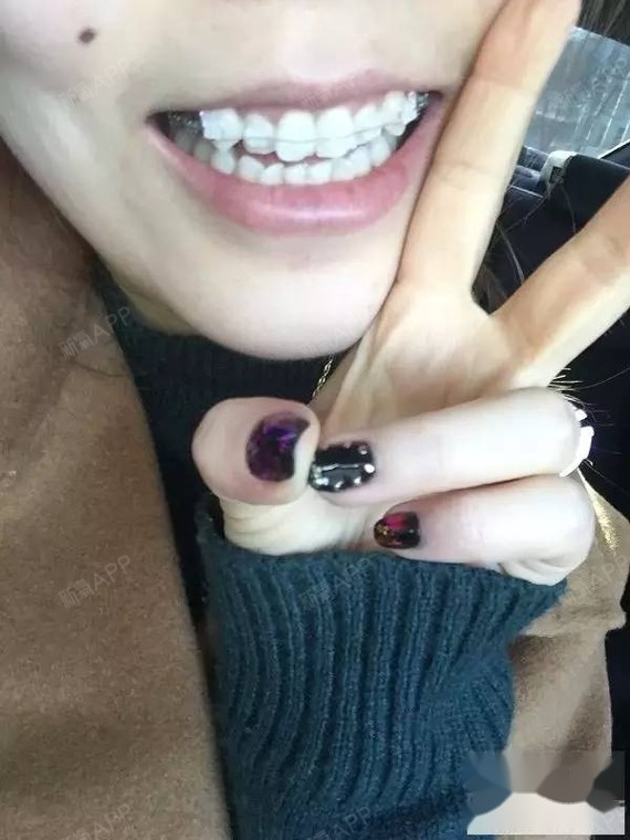 28牙妹蜕变之旅~水晶金属牙套,想改变何时都不晚