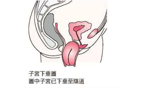 子宫脱垂悄悄的来了,又让我悄悄的撵走了.