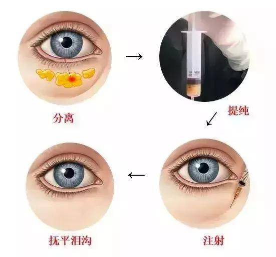 去眼袋+泪沟后真的变年轻了!同事都追着问我在