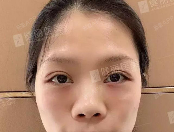 去眼袋+泪沟后真的变年轻了!同事都追着问我在