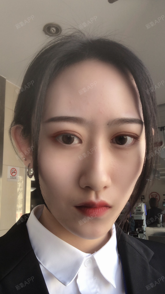 啦啦啦,我又来啦,亲们,这是打完瘦脸针之后第一次自_圈子-新氧美容