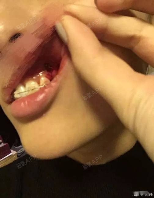 埋伏牙牵引一年终于下来了