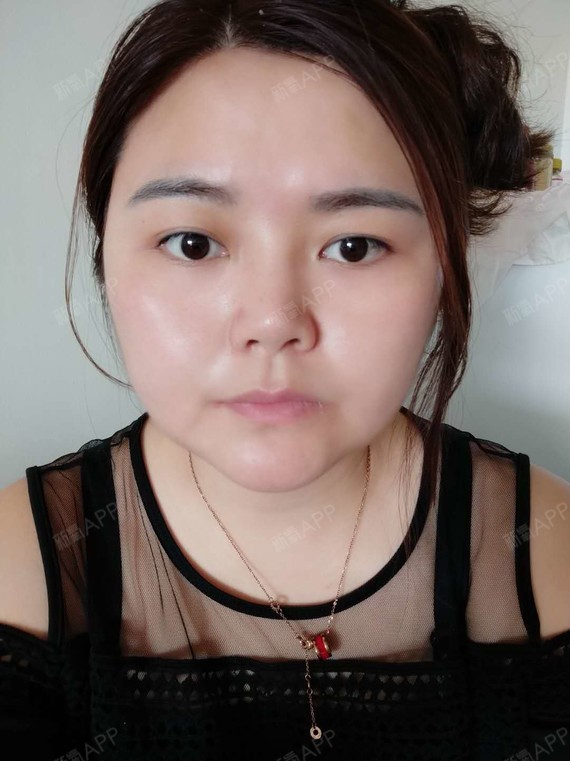 一个半月了,因为我脸部脂肪太多了,减肥一下子减不下_圈子-新氧美容