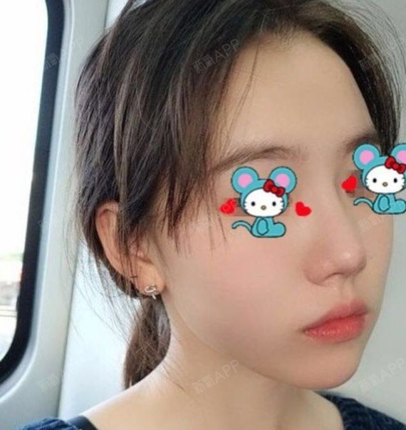 我的鼻子问题:鼻小柱短小,鼻翼宽大,整个人看上去都_圈子-新氧美容
