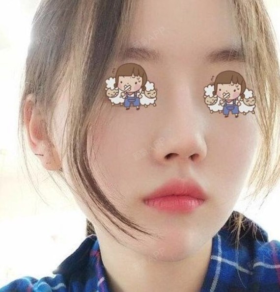 我的鼻子问题:鼻小柱短小,鼻翼宽大,整个人看上去都_圈子-新氧美容