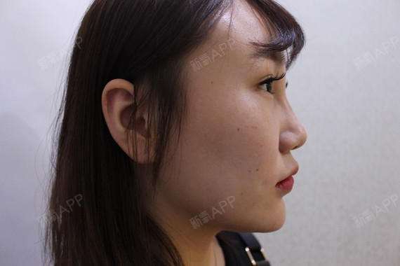 之前有好多宝宝问我关于超体隆鼻的材料,优势,以及是否安全的问题,这