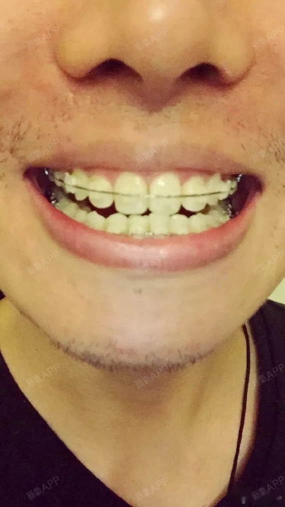 摘掉牙套3个月后的效果图.