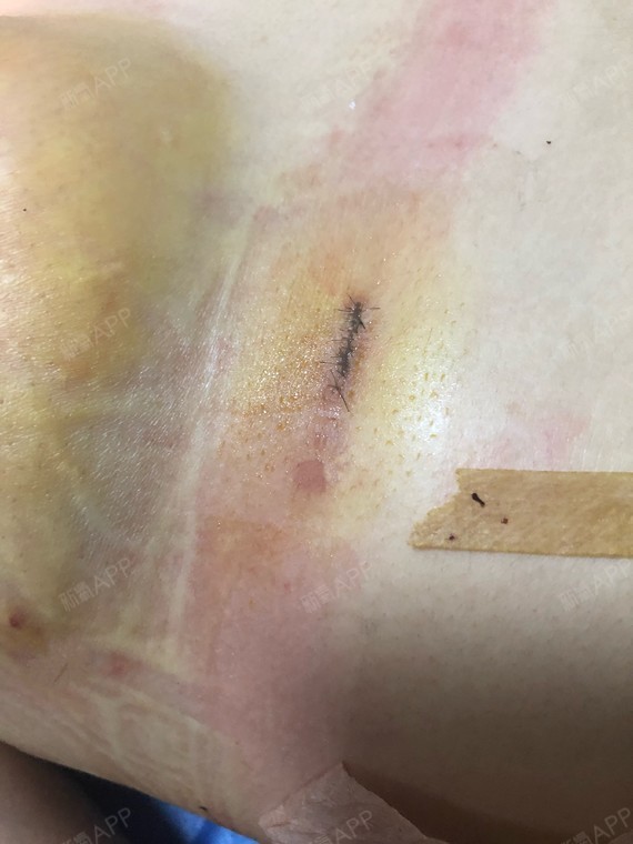 乳房提升术后留疤图片图片