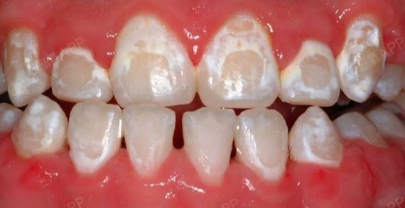 牙齿脱矿是指人的牙齿牙釉质表面的钙磷脱落,因而使牙