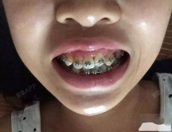 重叠的牙正在牙套中