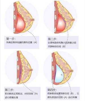 使假體摸起來堅硬,並且有時還會導致假體移位,進而扭曲乳房形狀