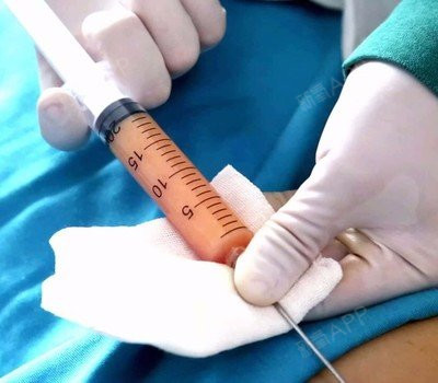 自体脂肪丰胸效果怎样?安全吗?好不好?疼不疼