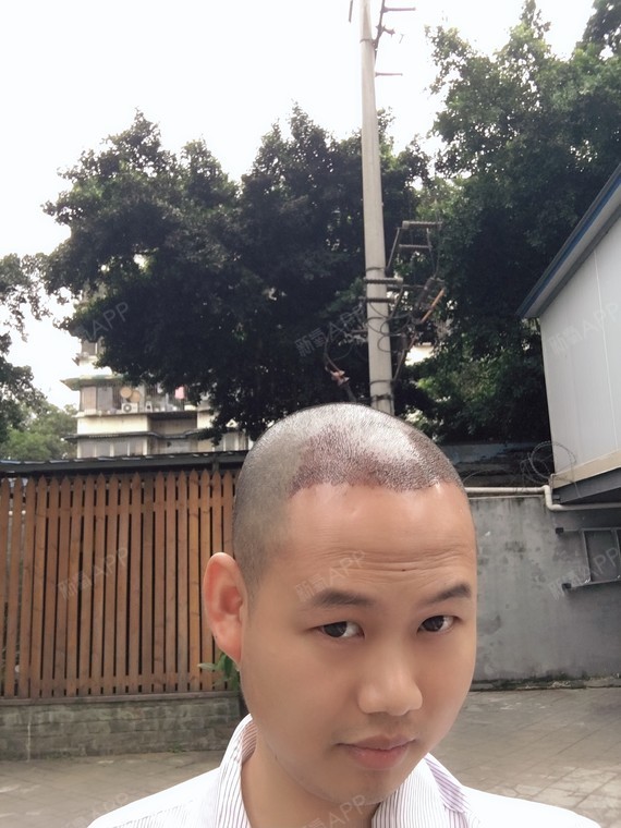 今天额头明显的有一点水肿,头皮结痂了开始发痒,又不能抠,难受