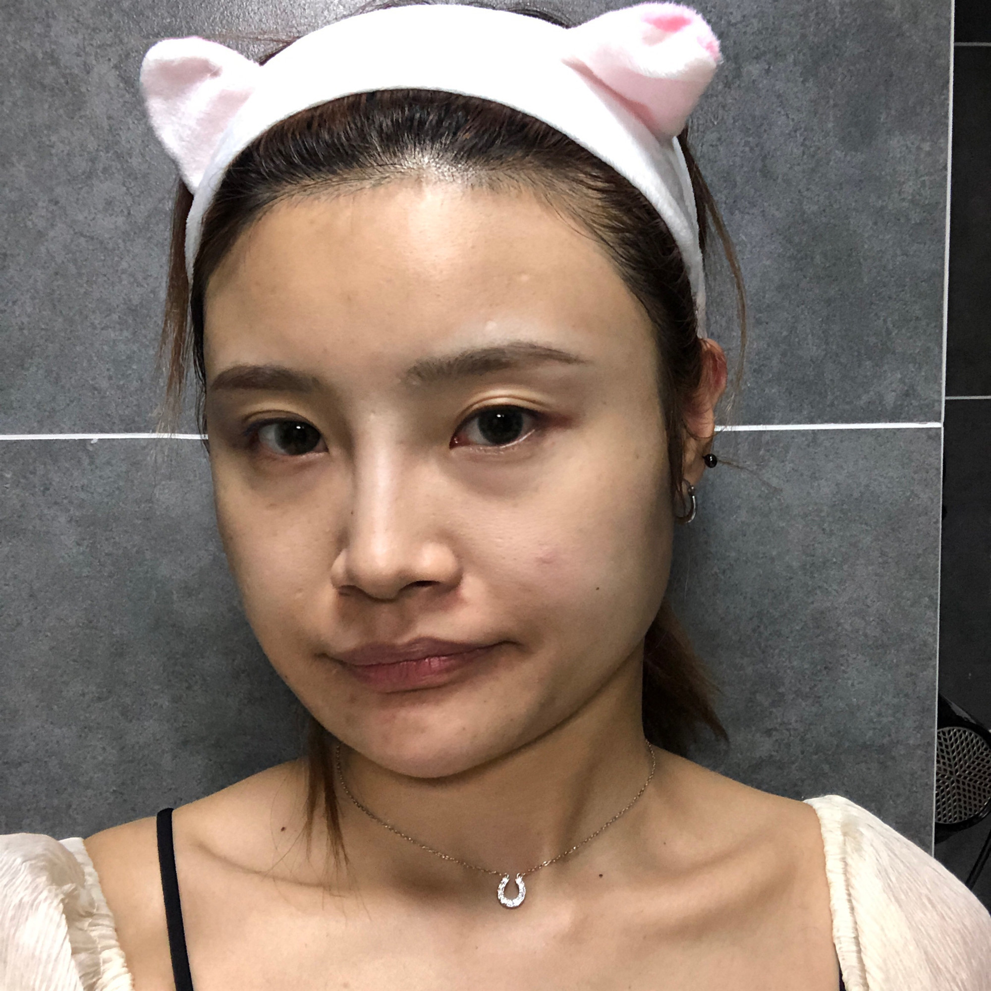 最容易脂肪填充失败(脂肪过量,凹凸不平)的部位有哪些?