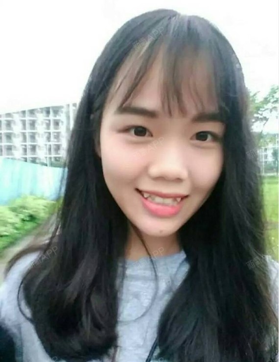 虎牙 兔牙,矫正中途拔牙.终于拆牙套了,走着路回去_圈子-新氧美容整形