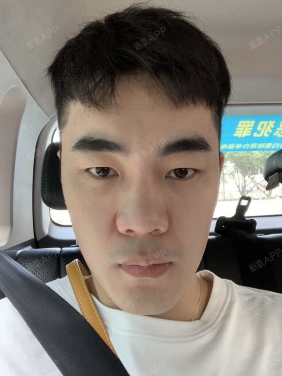 一个有眼袋的男人不能称之为帅哥,我自认为术后还是比_圈子-新氧美容