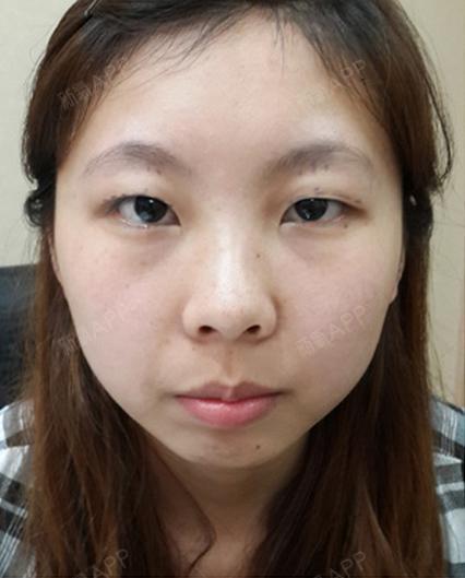 单眼皮困扰了我20年,一直都有想去做双眼皮的想法,_圈子-新氧美容整形