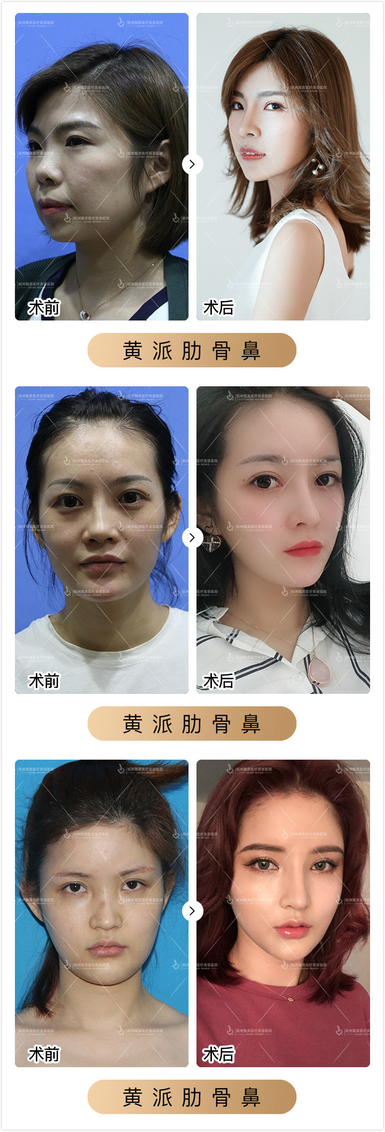 有过敏性鼻炎能不能两隆鼻 新氧美容整形