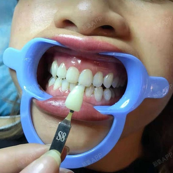 冷光美白靠谱吗?#从齿开始未来可期冷光美白