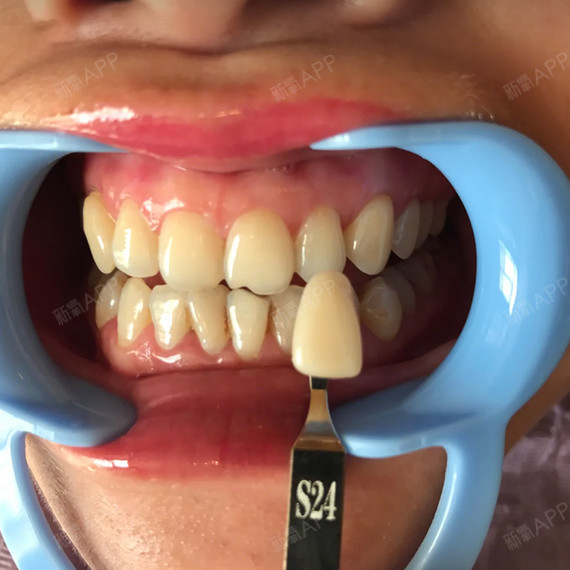 冷光美白靠谱吗?#从齿开始未来可期冷光美白