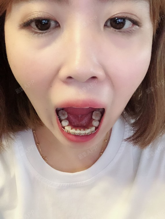 牙齿正畸究竟要不要拔牙?#从齿开始 未来可期#拔牙后有危害吗?