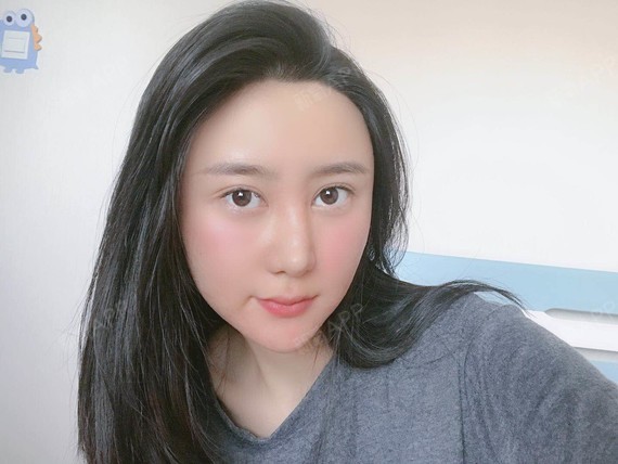 注射完一周~嘴巴嘟嘟的,已经不肿了,刚刚打出来就有_圈子-新氧美容