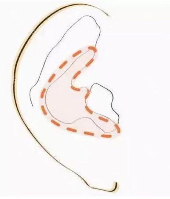 关于耳软骨会被吸收吗?