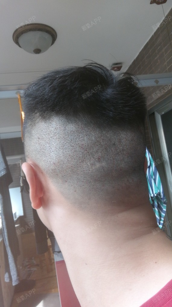 植发后第二天,拆了纱布恢复得挺好的,没有肿胀,也没_圈子-新氧美容