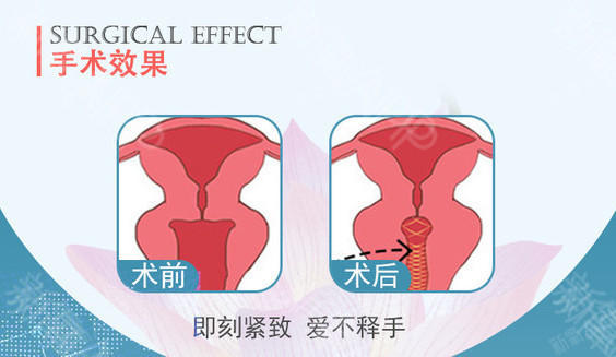 做激光紧缩阴道有副作用吗激光紧缩阴道基本没有副作用 圈子 新氧美容整形