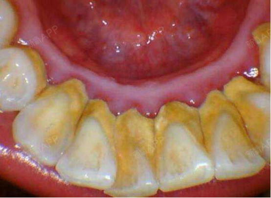 洗牙後為什麼醫生還要建議做牙周刮治