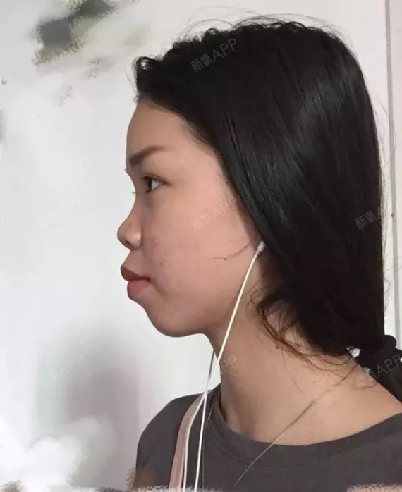 拔了四颗四矫正,拿去年刚戴牙套的图片对比,瞬间觉得_圈子-新氧美容