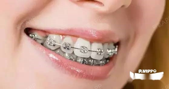 常规金属托槽矫正(金属牙套)最常用的牙齿矫正方法,