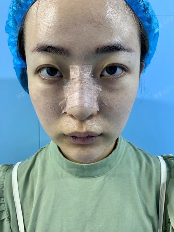 再过2天鼻子就可以去拆线了,鼻子现在还是肿肿的,不_圈子-新氧美容