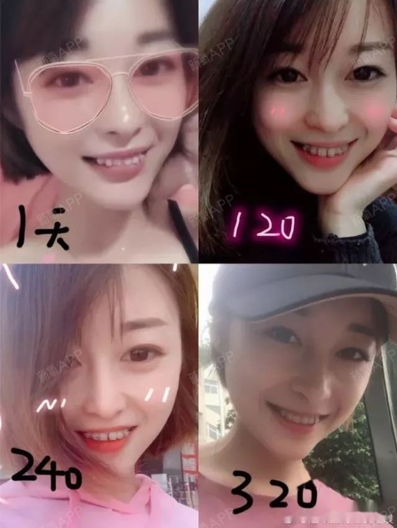 戴牙套一年的变化~看到以前牙齿不知道我是怎么活20多年的