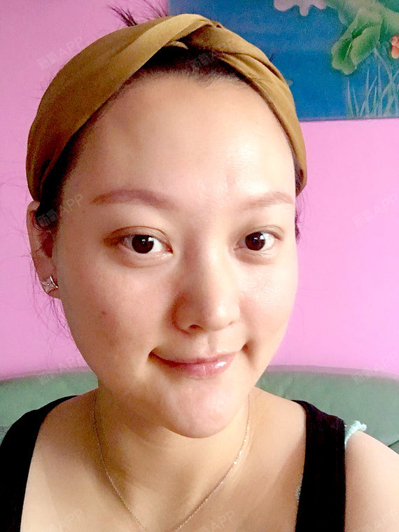 做完溶脂已经一周多了,现在效果慢慢的已经出来了,我_圈子-新氧美容
