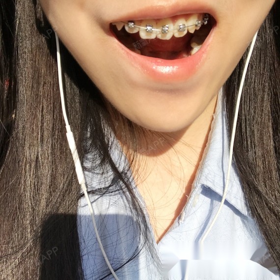 性别女,今年23岁未满,2017年2月15开始戴牙_圈子-新氧美容整形